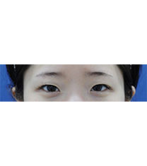 韩国SL双眼皮手术6天恢复案例前后