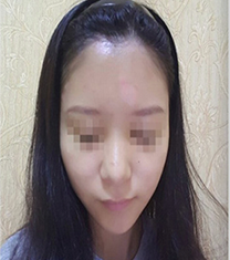 韩国koko鼻部修复手术对比日记_术前
