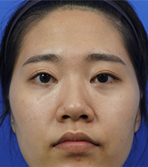 韩国koko面部轮廓+鼻部整形手术案例