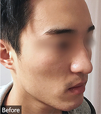 韩国优尼克男士鼻整形真人案例对比