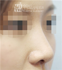 维德整形外科-韩国维德驼峰鼻整形日记3个月恢复对比图