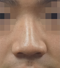 韩国koko医院男士鼻翼整形手术案例