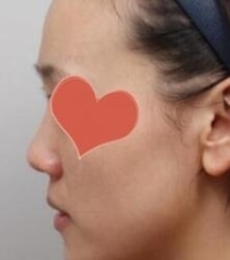 韩国高诺鼻鼻部整形前后对比照片