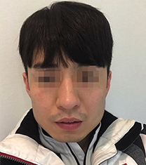 韩国TL男士v脸整形案例对比_术后