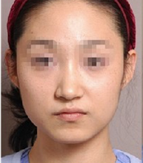哈尔滨大韩国际整形医院面部吸脂手术案例
