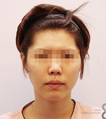 韩国A特整形面部脂肪填充手术案例