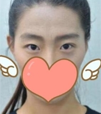 海南瑞韩医学美容医院-海南瑞韩刘申松眼部整形前后对比照片