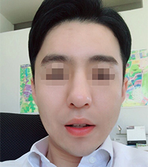 韩国TL男士v脸整形日记对比