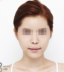 韩国A特整形面部脂肪填充手术案例