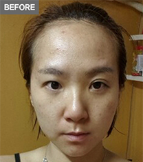 韩国A特整形医院双眼皮修复手术对比日记