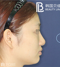 韩国贝缇莱茵医院面部脂肪填充手术案例
