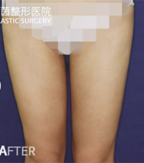 韩国贝缇莱茵腿部吸脂手术案例