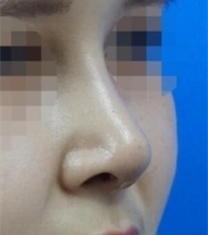 韩国KOKO整形医院-韩国KOKO整形医院朝天鼻矫正前后照片
