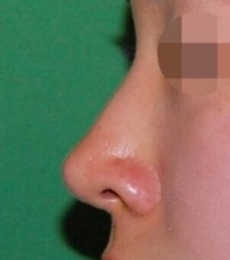韩国KOKO整形医院驼峰鼻矫正手术前后照片_术后