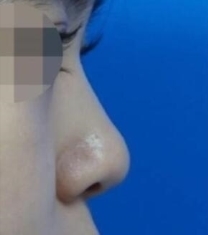 韩国Koko曹倍正短鼻矫正前后对比照片