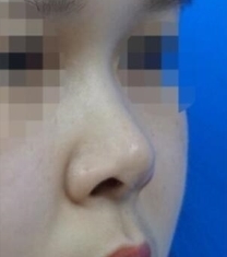 韩国KOKO整形医院-韩国KOKO整形医院朝天鼻矫正前后照片