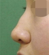 韩国KOKO整形医院驼峰鼻矫正手术前后照片_术前