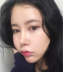 韩国Thenan鼻综合+面部脂肪移植案例前后对比