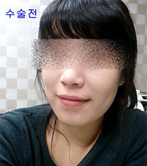 韩国伍人整形外科-韩国伍人整形外科下颌角案例照片