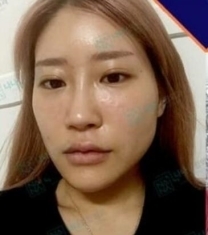 韩国NANA娜娜崔相錄轮廓整形前后照片