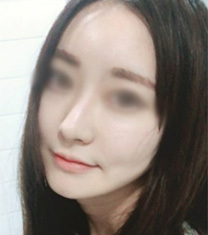 韩国伍人整形外科-韩国伍人魏圣润医生下颌角整形前后对比照片