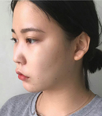 韩国Thenan鼻综合+面部脂肪移植日记前后对比