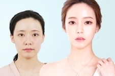 韩国面部整形价格像颧骨、下颌角、下巴分别多少钱？