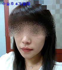 韩国伍人整形外科-韩国伍人整形外科下颌角日记照片