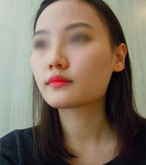 韩国伍人整形外科-韩国伍人整形医院颧骨+下颌角术前术后案例