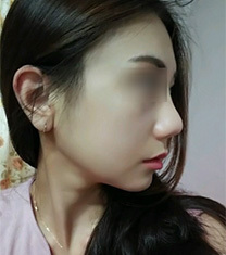 韩国伍人下颌角整形网红小姐姐恢复照片