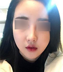 韩国nano混血鼻修复超惊艳真人日记对比