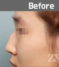 韩国zestar整形外科驼峰鼻矫正真人对比
