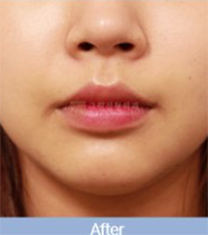 韩国格林整形医院唇部下垂矫正手术案例
