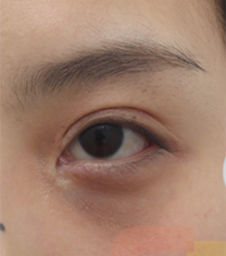 韩国芙莱思整形-韩国芙莱思整形医院双眼皮修复手术对比案例