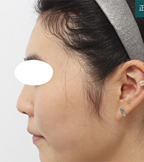 韩国芙莱思整形-韩国芙莱思整形医院隆鼻手术对比案例
