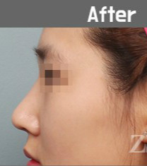 韩国zestar整形外科驼峰鼻矫正真人对比