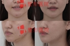 白汀桓做下颌角在韩国当地能排第几，修复手术真的强？