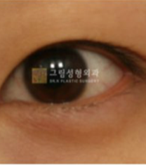 韩国格林整形-韩国格林整形医院双眼皮手术日记