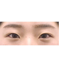 韩国Rio丽偶双眼皮手术真人案例自拍对比