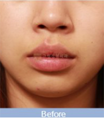 韩国格林整形医院唇部下垂矫正手术案例