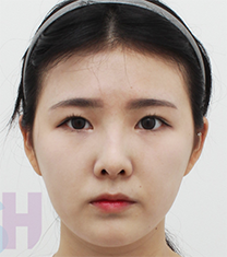 韩国芙莱思整形-韩国芙莱思整形医院面部吸脂手术对比案例