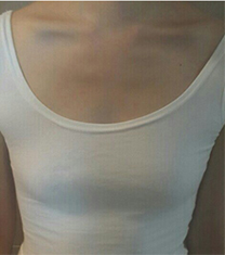 韩国rio丽偶整形外科假体隆胸案例真人自拍对比