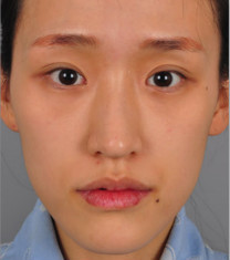 韩国sisun整形外科-韩国sisun整形外科全脸填充日记对比