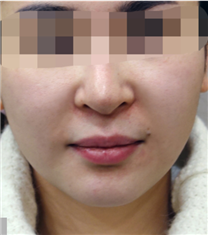 韩国美lab皮肤科埋线提升案例对比_术后