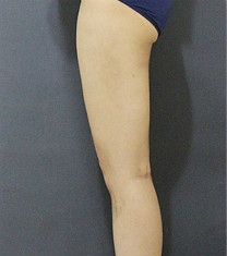 韩国爱林整形外科吸脂瘦大腿日记对比