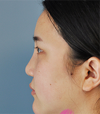 韩国sisun视线整形外科自体软骨隆鼻案例前后对比