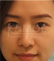 韩国咖蒙国际整形医院-泰国咖蒙整形医院双眼皮日记对比