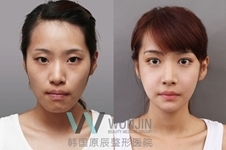 韩国原辰整形医院，隆胸和面部轮廓整形哪种手术更有名？