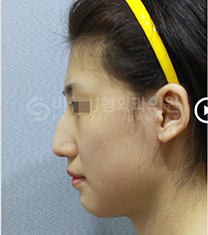 韩国BN整形外科-韩国BN驼峰鼻矫正前后日记自拍对比
