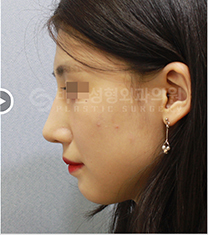 韩国BN驼峰鼻矫正前后案例自拍对比_术后